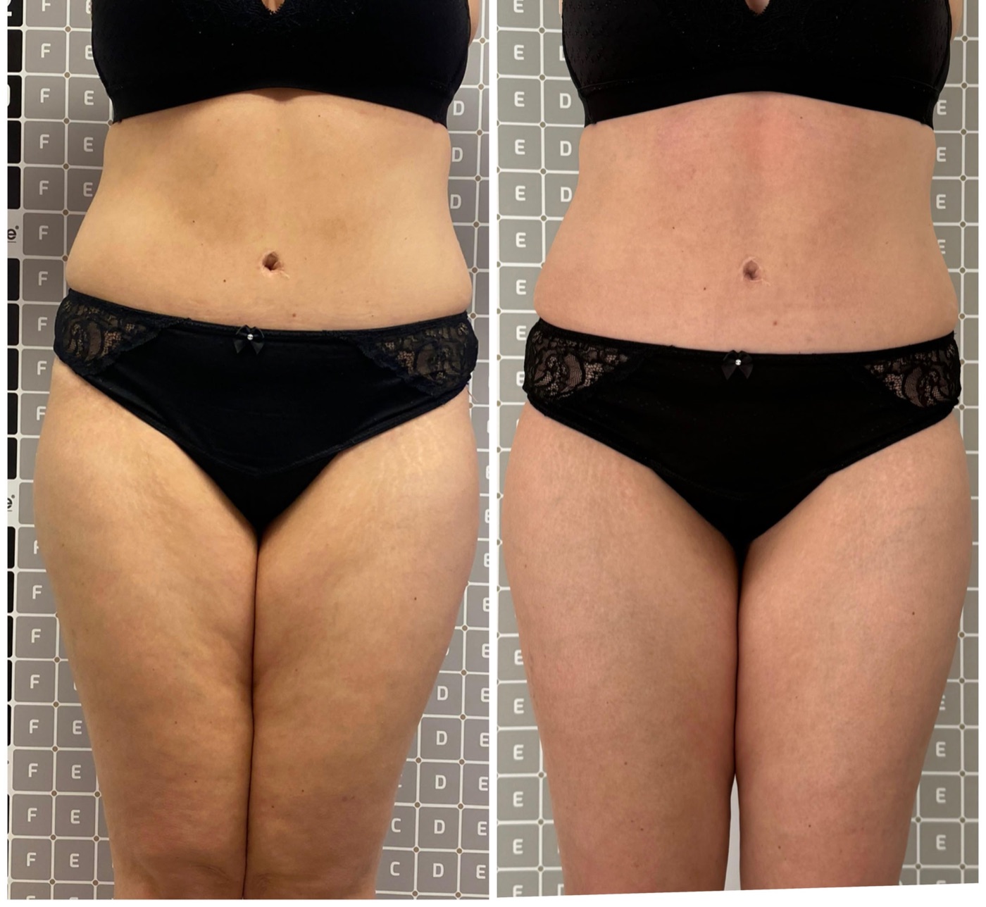 Vorher-Nachher: Bauch und Oberschenkel nach Liposana 3 Plus bei Bella's Beauty in Dortmund