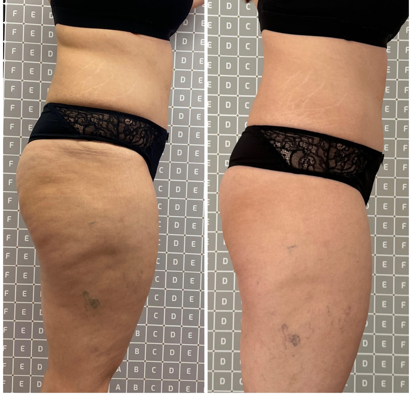 Vorher-Nachher: Oberschenkel und Hüfte nach Liposana 3 Plus bei Bella's Beauty in Dortmund